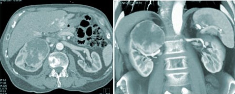 CT scan renal tumour