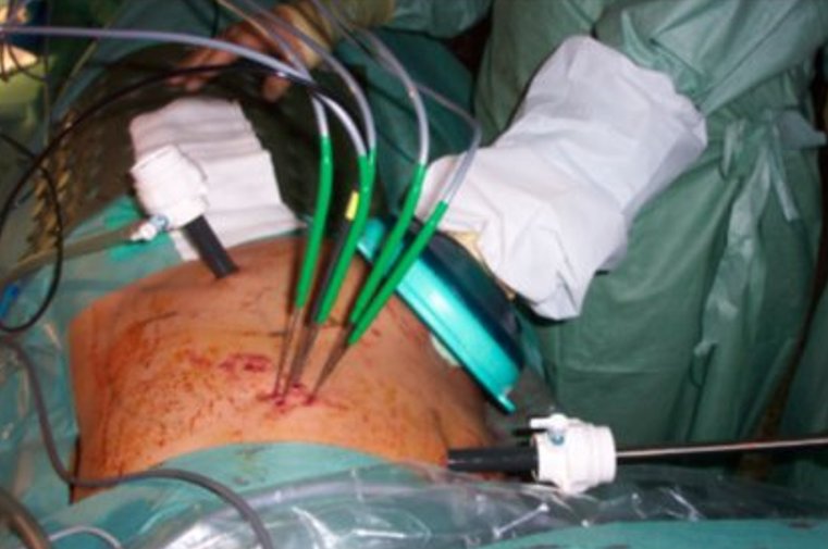 hand assisted laparoscopic renal Cryotherapy. Note the inserted cryotherapy needles