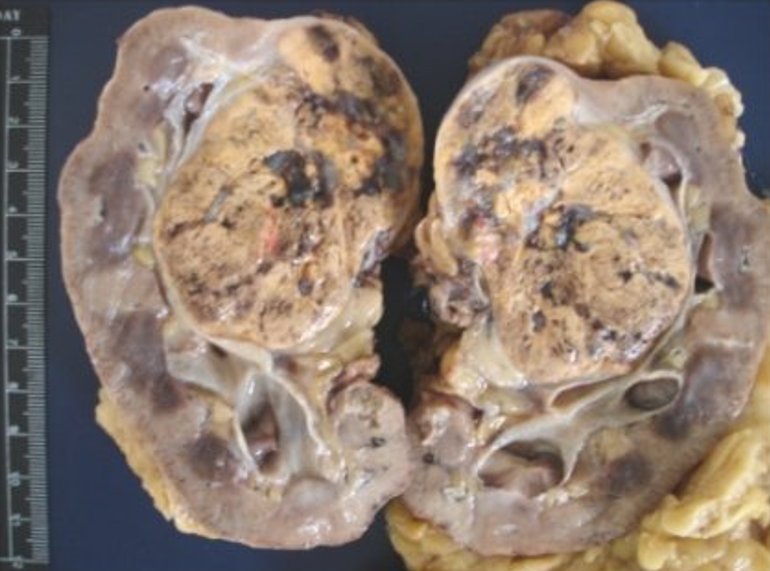 large renal tumour