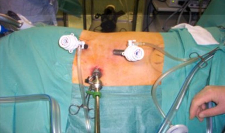 port placements for transperitoneal laparoscopic nephrectomy