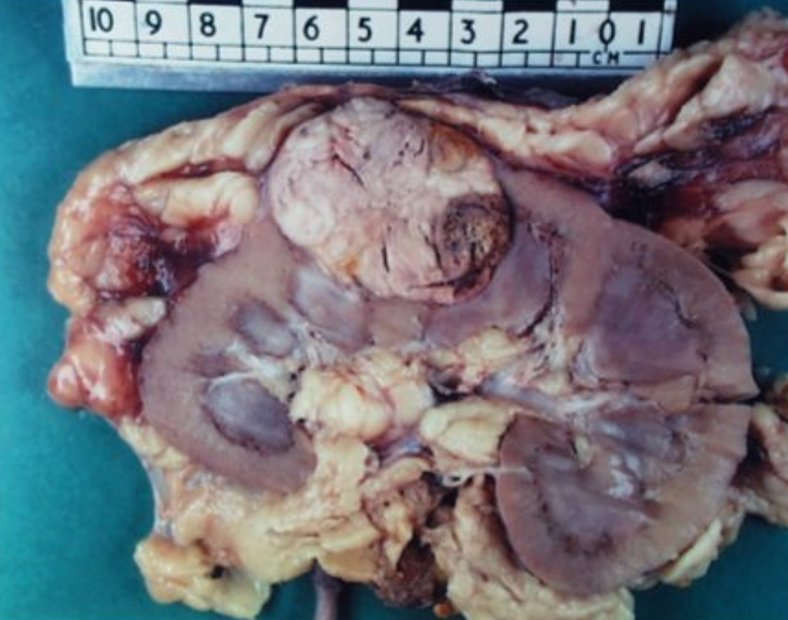 smaller renal tumour