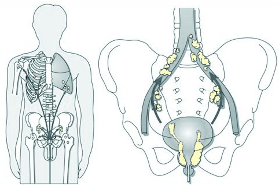 spread to lymphnodes